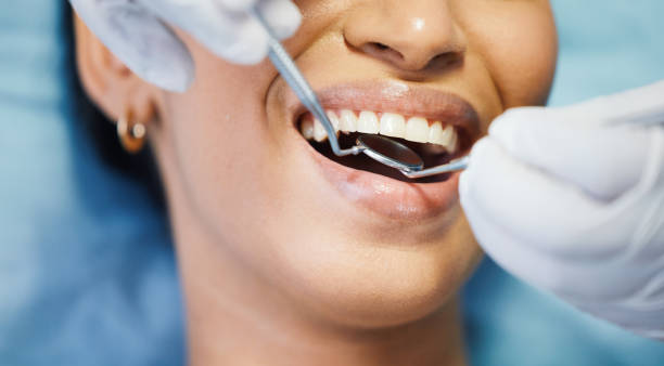 Best Emergency Wisdom Teeth Removal in Salina, UT